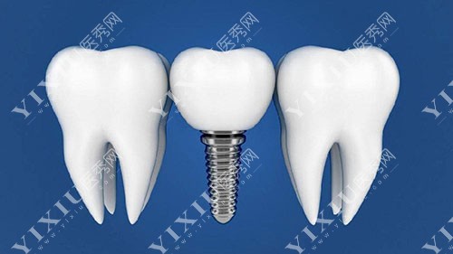 详解北京种植牙植骨价格是多少,看植骨种植牙费用要多少钱!(图1)