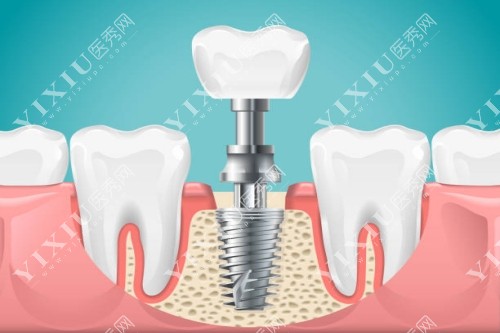 种植牙安装模型图