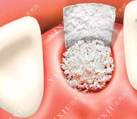 详解北京种植牙植骨价格是多少,看植骨种植牙费用要多少钱!(图5)