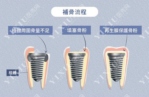 详解北京种植牙植骨价格是多少,看植骨种植牙费用要多少钱!(图4)
