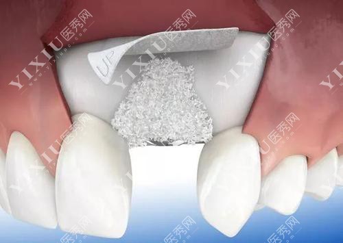 详解北京种植牙植骨价格是多少,看植骨种植牙费用要多少钱!(图2)