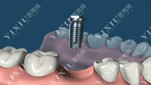 瑞士种植牙的过程图片