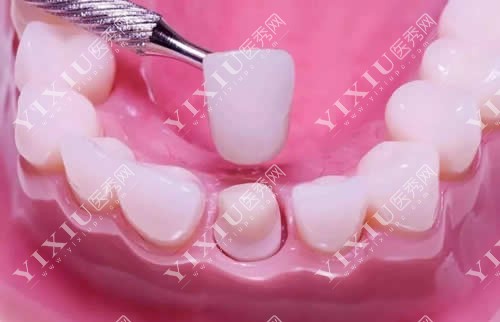 牙冠修复流程实拍