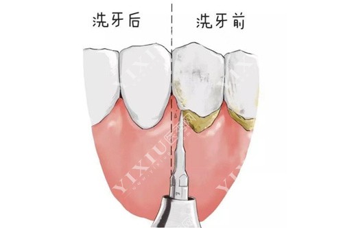 洗牙前后示意图