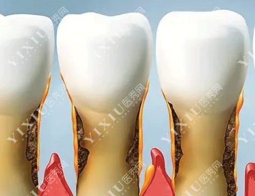 牙龈翻瓣术有必要做吗？做牙龈翻瓣手术后后悔了是啥原因？(图2)