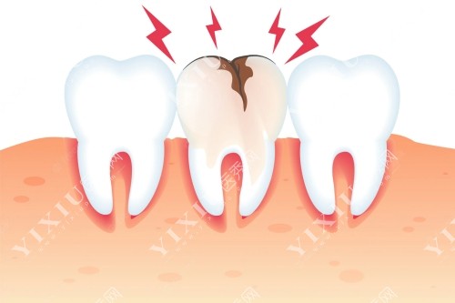 卡通牙齿损坏示意图