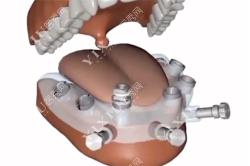 数字化种植牙模型实例图