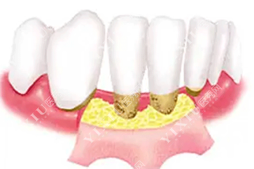 牙龈翻瓣术有必要做吗？做牙龈翻瓣手术后后悔了是啥原因？(图3)