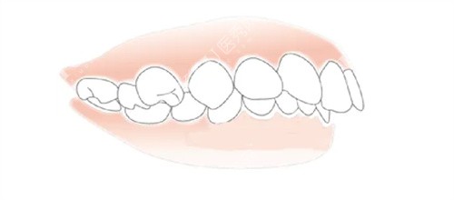 牙齿畸形图