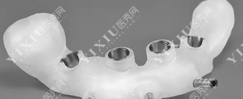 牙龈翻瓣术有必要做吗？做牙龈翻瓣手术后后悔了是啥原因？(图5)