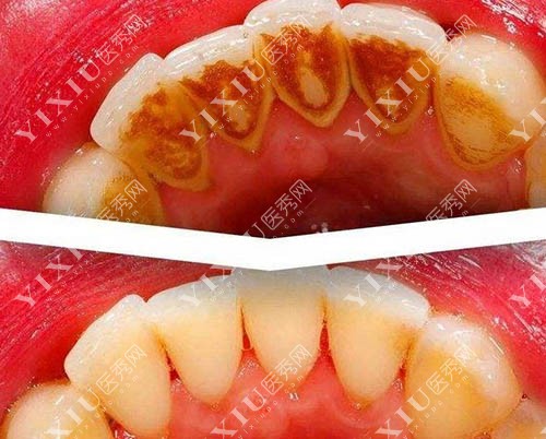 洗牙前后照片