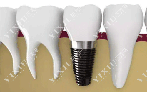 牙龈翻瓣术有必要做吗？做牙龈翻瓣手术后后悔了是啥原因？(图4)