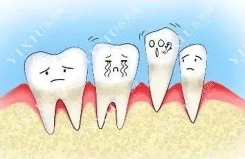 牙龈翻瓣术有必要做吗？做牙龈翻瓣手术后后悔了是啥原因？(图8)