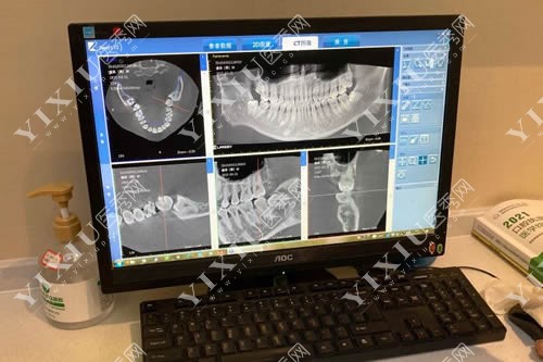 牙齿治疗术前CT图片拍摄