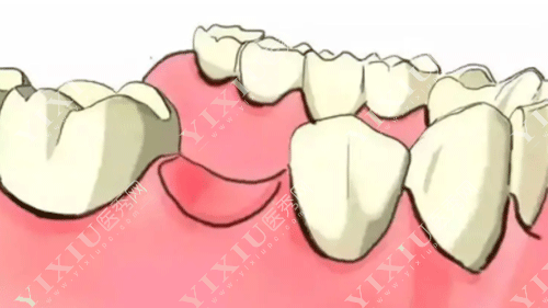 牙龈翻瓣术有必要做吗？做牙龈翻瓣手术后后悔了是啥原因？(图1)
