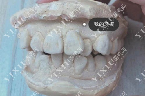 牙齿模具