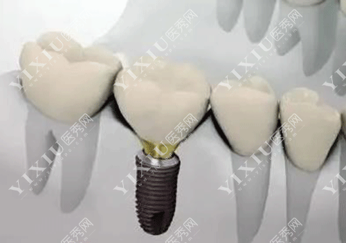 德国贝格种植体怎么样？从品牌历史／产品型号／价格／全方位为你解析！(图7)