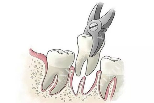 拔牙示意图