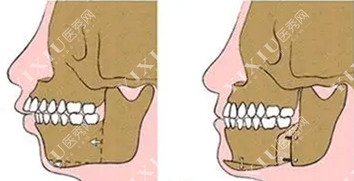 牙齿骨性畸形矫正的图片