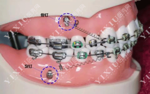 牙齿矫正打骨钉的图片