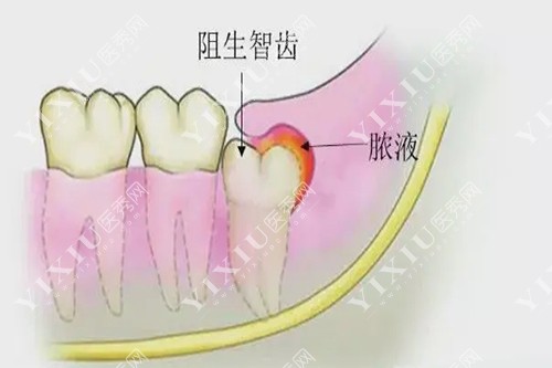 智齿阻生示意图