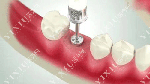 德国贝格种植体怎么样？从品牌历史／产品型号／价格／全方位为你解析！(图1)