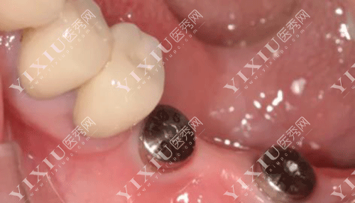 德国贝格种植体怎么样？从品牌历史／产品型号／价格／全方位为你解析！(图4)