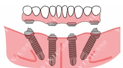 德国贝格种植体怎么样？从品牌历史／产品型号／价格／全方位为你解析！(图6)