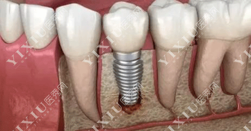 德国贝格种植体怎么样？从品牌历史／产品型号／价格／全方位为你解析！(图8)