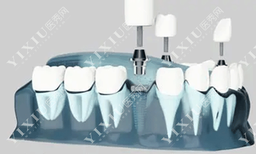 德国卡瓦种植牙怎么样?为啥牙友对德国卡瓦种植牙评价这么高?(图5) 德国卡瓦种植牙怎么样?为啥牙友对德国卡瓦种植牙评价这么高?(图5)