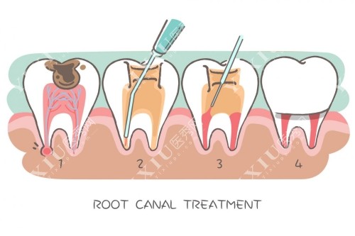 根管治疗过程卡通图