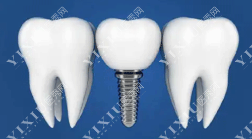 德国卡瓦种植牙怎么样?为啥牙友对德国卡瓦种植牙评价这么高?(图6) 德国卡瓦种植牙怎么样?为啥牙友对德国卡瓦种植牙评价这么高?(图6)