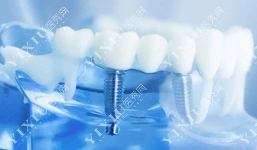 德国卡瓦种植牙怎么样?为啥牙友对德国卡瓦种植牙评价这么高?(图1) 德国卡瓦种植牙怎么样?为啥牙友对德国卡瓦种植牙评价这么高?(图1)