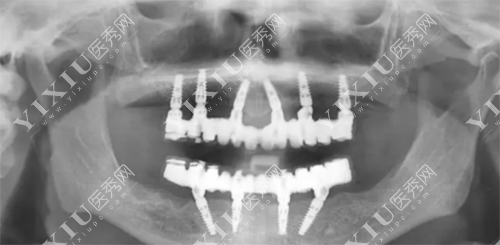 德国卡瓦种植牙怎么样?为啥牙友对德国卡瓦种植牙评价这么高?(图3) 德国卡瓦种植牙怎么样?为啥牙友对德国卡瓦种植牙评价这么高?(图3)