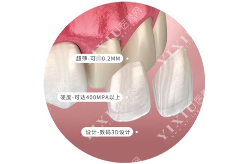 牙齿美学贴面示意图
