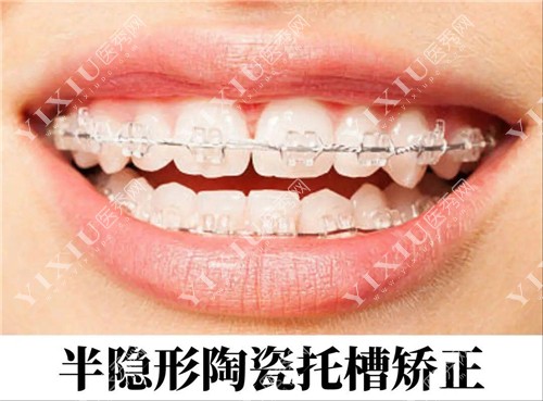 半隐形陶瓷托槽矫正示意图