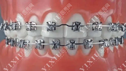 门牙假的可以矫正牙齿吗?有假牙能带牙套矫正吗?(图2) 门牙假的可以矫正牙齿吗?有假牙能带牙套矫正吗?(图2)