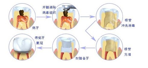 吉林市德仁口腔根管示意图