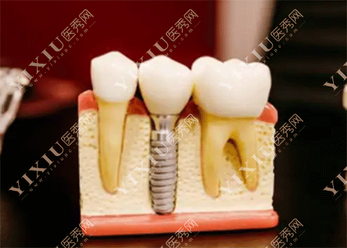 门牙假的可以矫正牙齿吗?有假牙能带牙套矫正吗?(图6) 门牙假的可以矫正牙齿吗?有假牙能带牙套矫正吗?(图6)