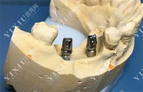 种植牙模型图
