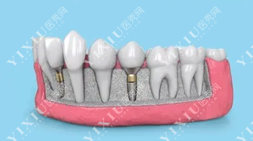 门牙假的可以矫正牙齿吗?有假牙能带牙套矫正吗?(图4) 门牙假的可以矫正牙齿吗?有假牙能带牙套矫正吗?(图4)