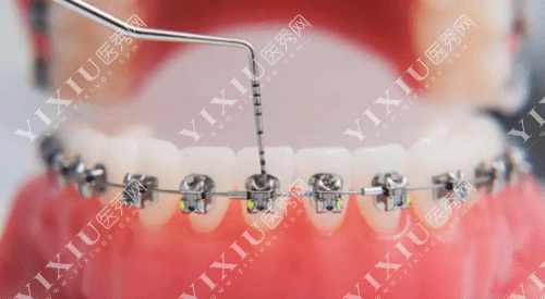 大学生23岁整牙之后后悔了！后悔的原因竟然是这个!(图3)