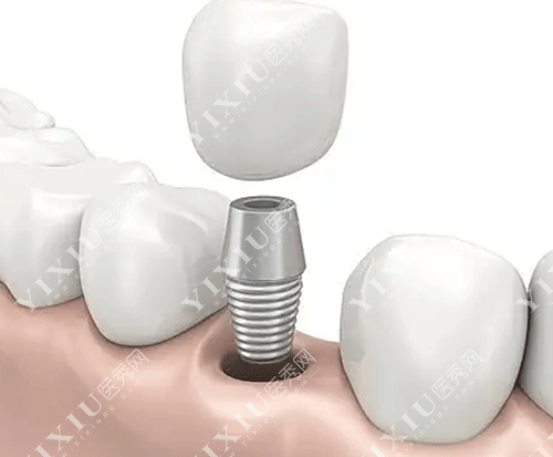 德国icx种植体怎么样?从价格/型号/特点/带你了解!-医秀网