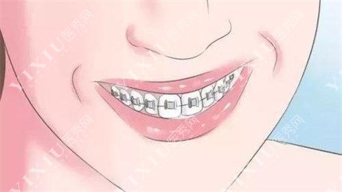 牙齿矫正示意图