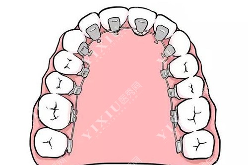 舌侧矫治器示意图