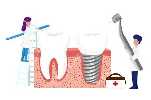 种植牙维护