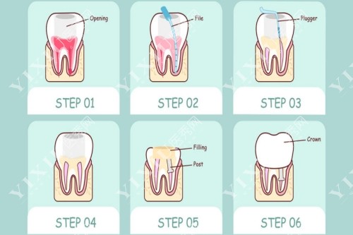 根管治疗卡通示意图
