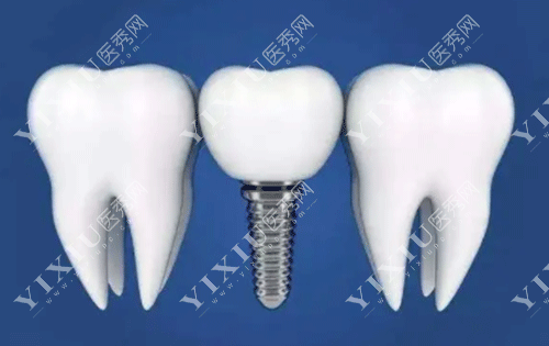 德国icx种植体怎么样?从价格/型号/特点/带你了解!-医秀网