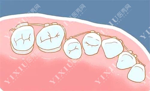 吉林桦甸矫正牙齿示意图