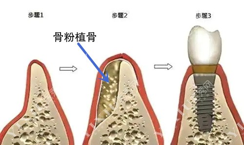 骨粉植骨过程